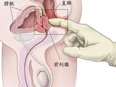 前列腺越“老”越大，忍还是切？