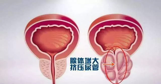 前列腺越“老”越大，忍还是切？